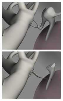 3D Visualisierung, Operativer Eingriff bei der Mittelohrerkrankung «Otosklerose»